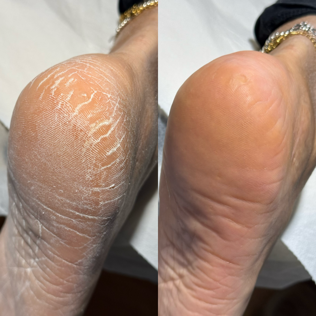 Pedicure 1+2 (ACCONTO)